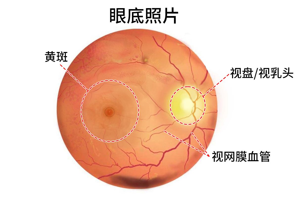 糖尿病视网膜病变,左眼眼底出血黄斑水肿