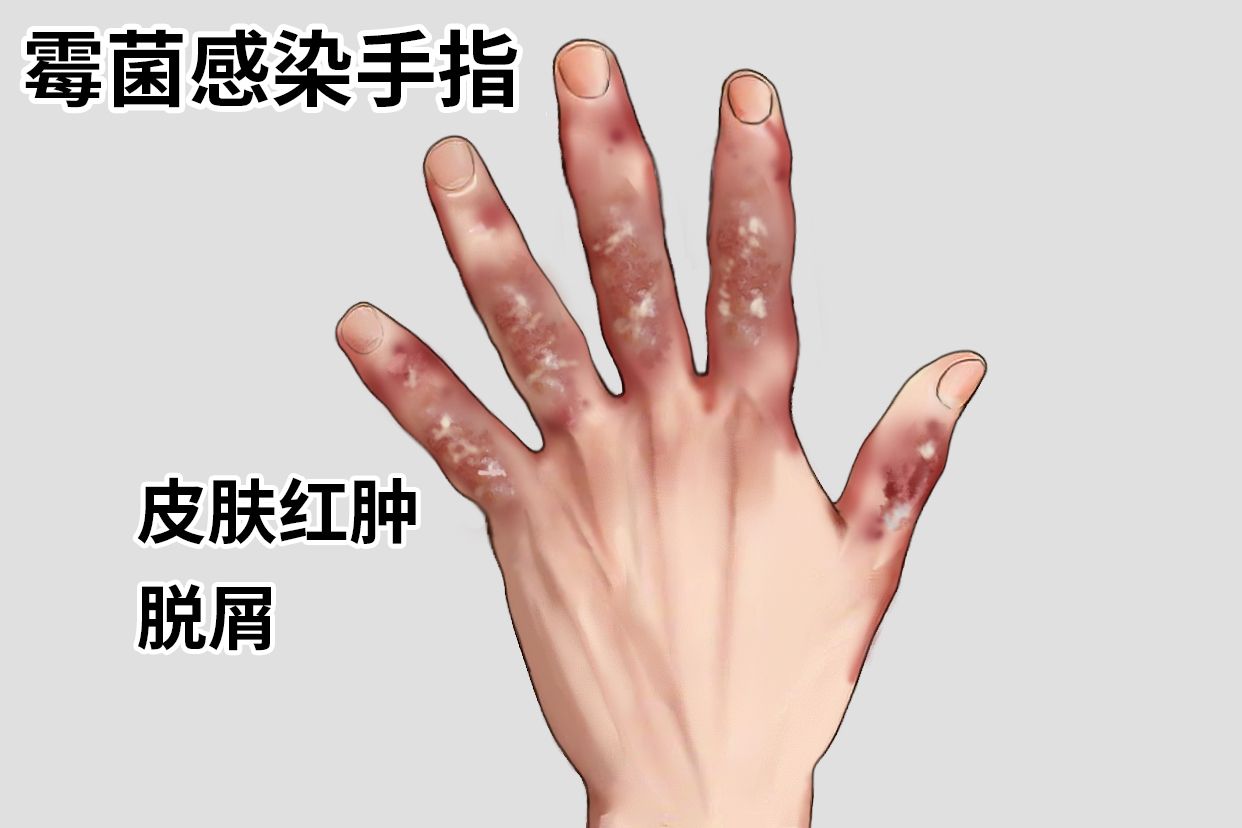 霉菌感染手指怎么治疗