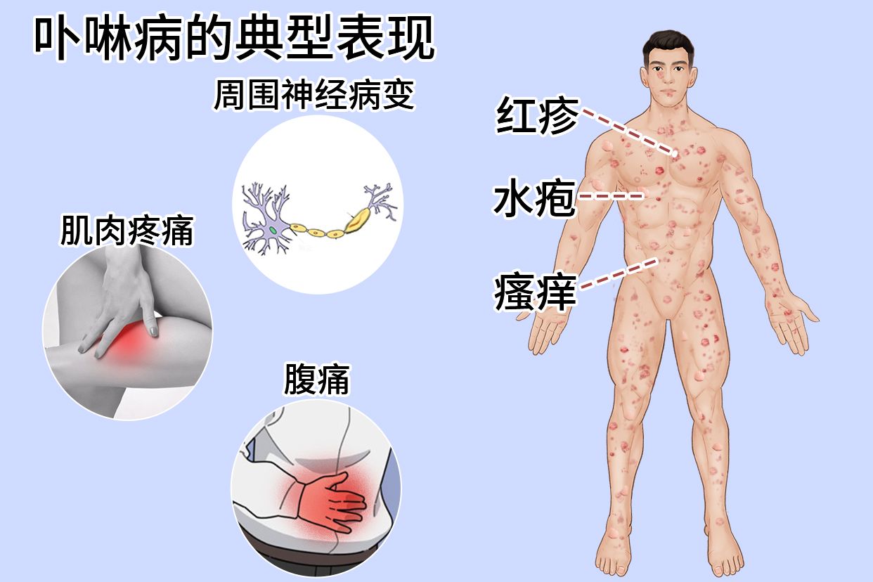 卟啉症怎么患上的