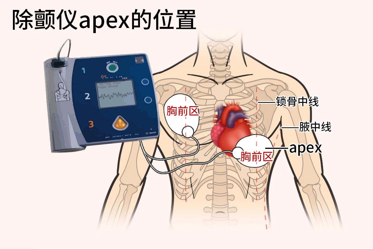 自动体外除颤仪(AED)该如何正确使用?