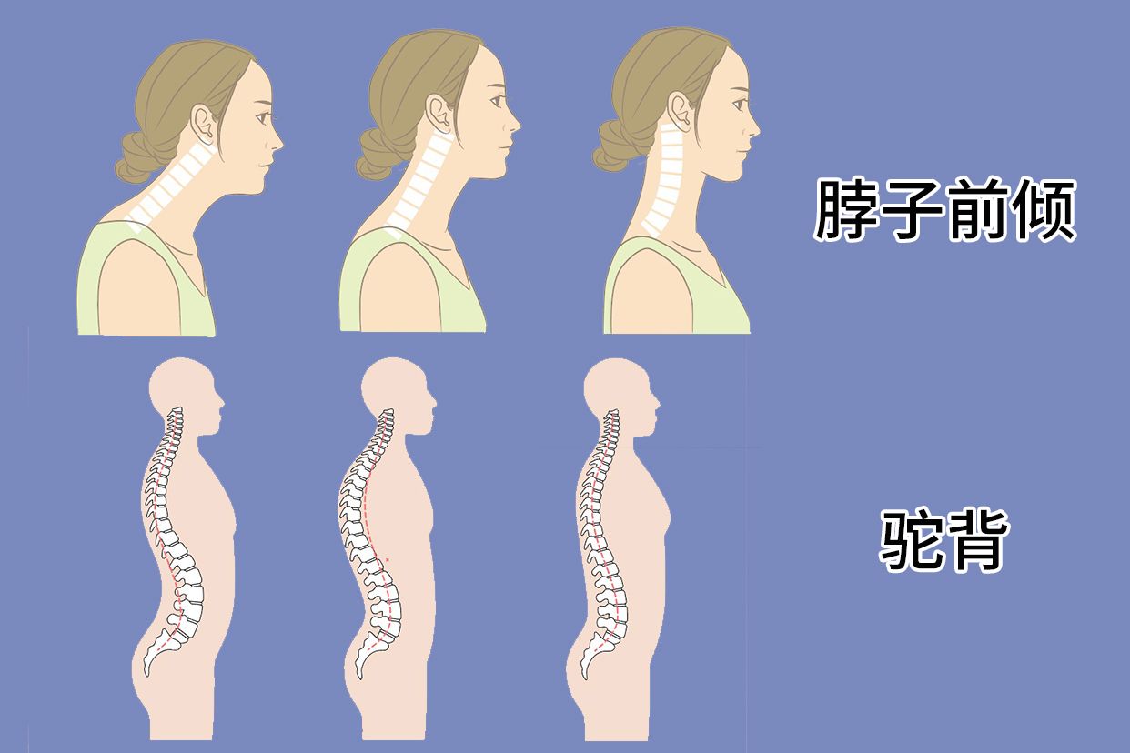 体态矫正!4个动作改善脖子前倾,含胸驼背!