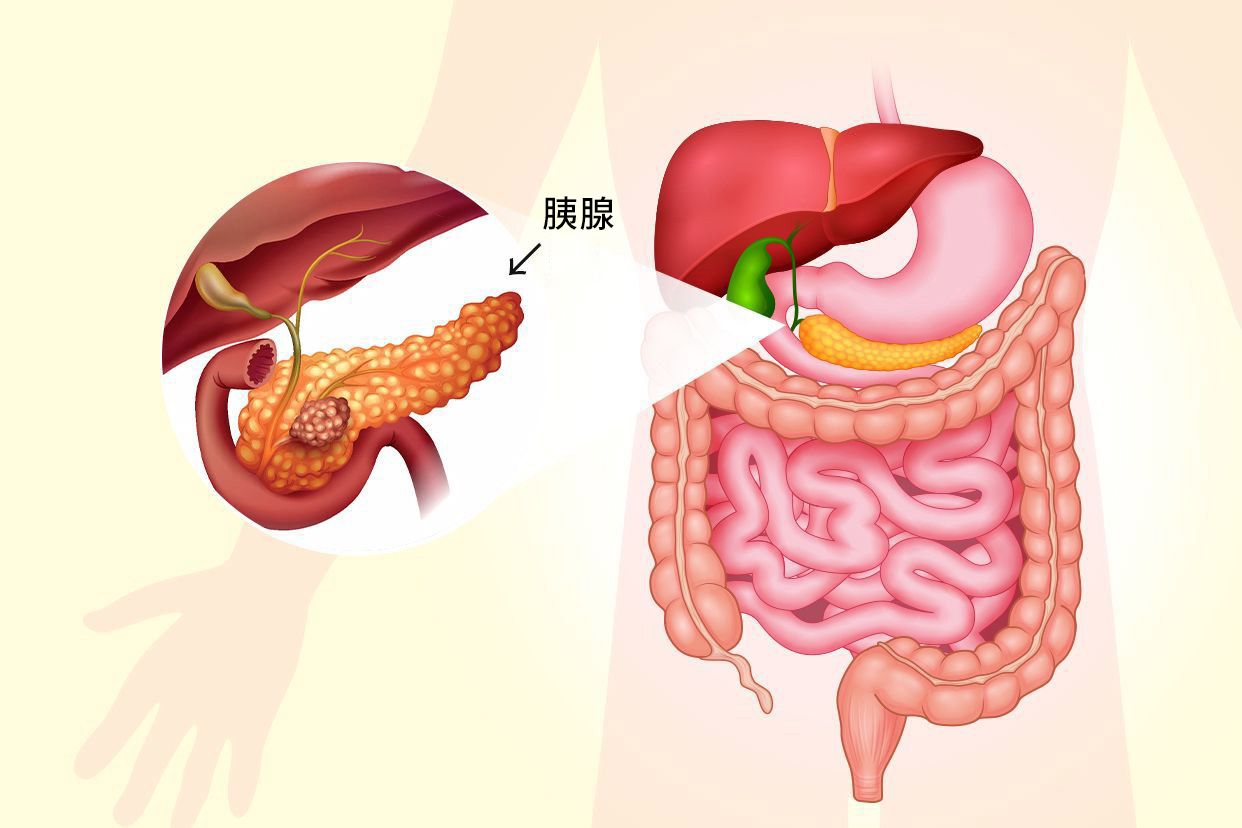 胃疼切记注意|急性胆源性胰腺炎