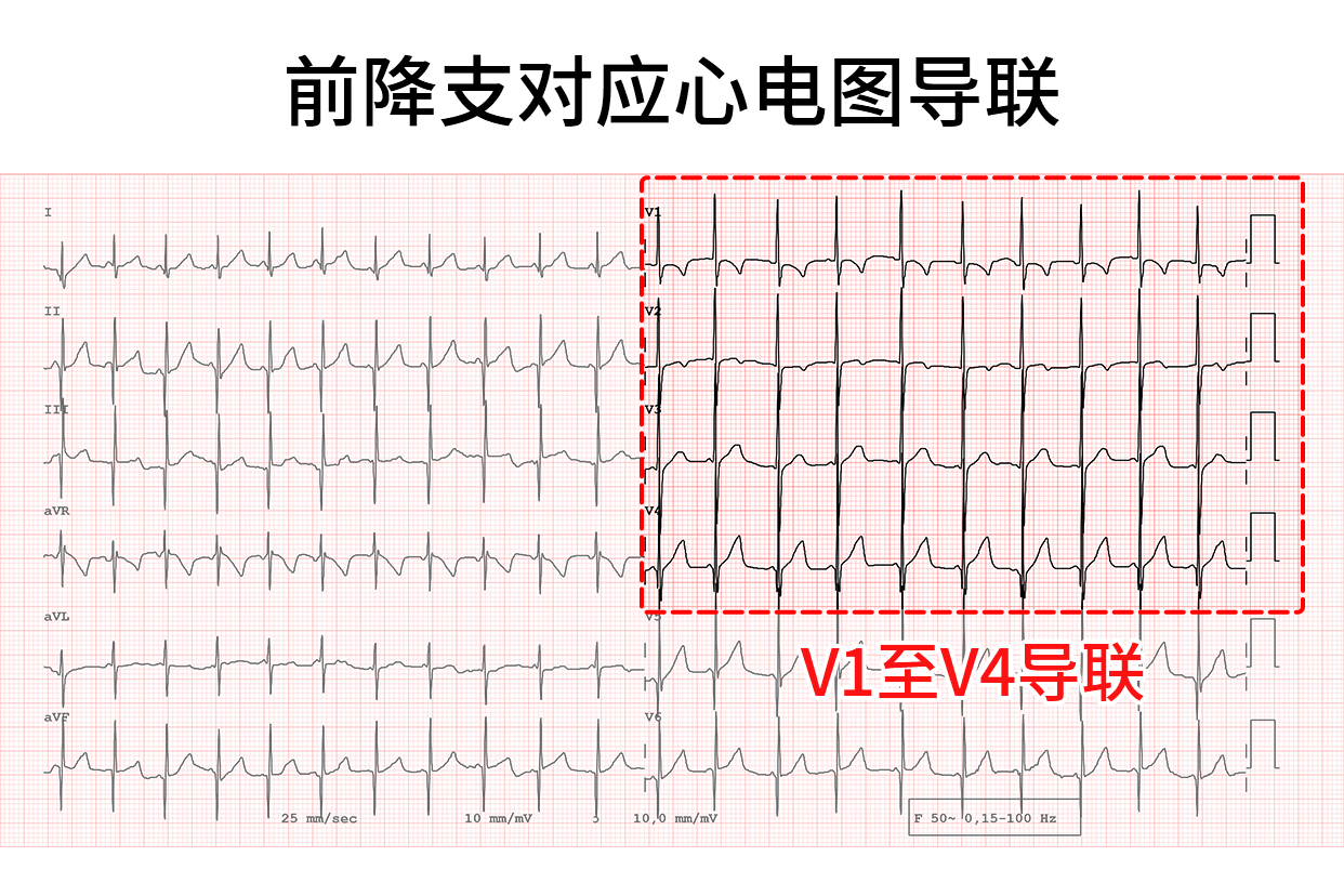 前降支中段闭塞,右冠多处狭窄,能逆转吗?