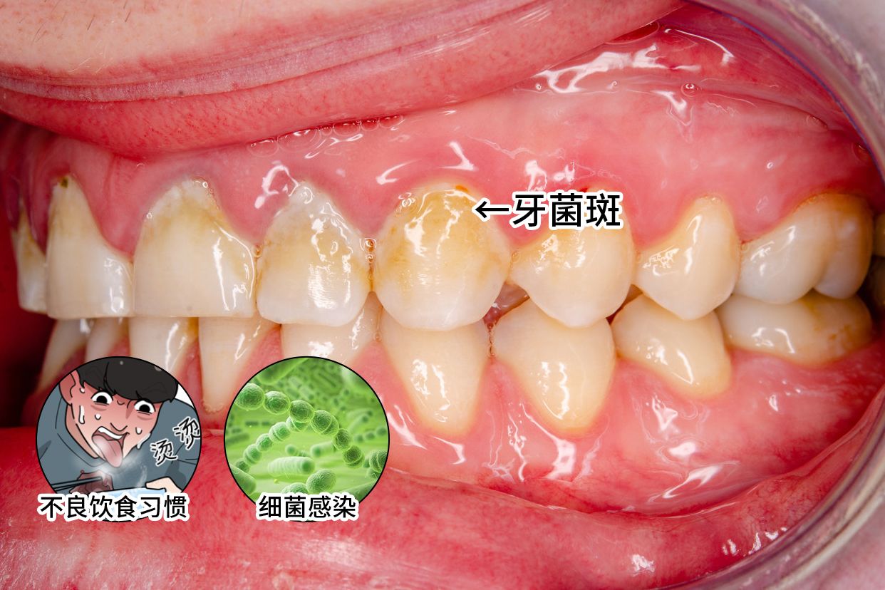 牙斑菌那么多该怎么清除呢?
