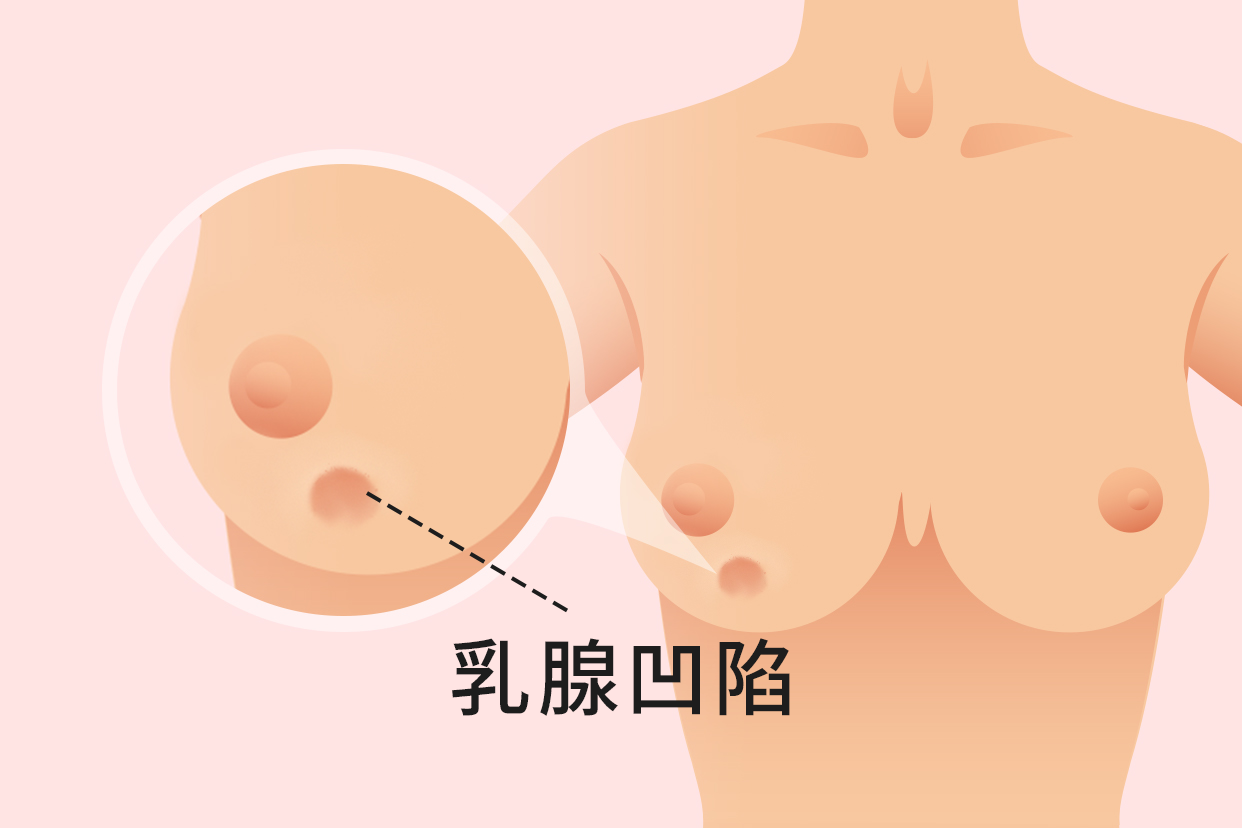 乳腺凹陷一定是乳腺癌吗