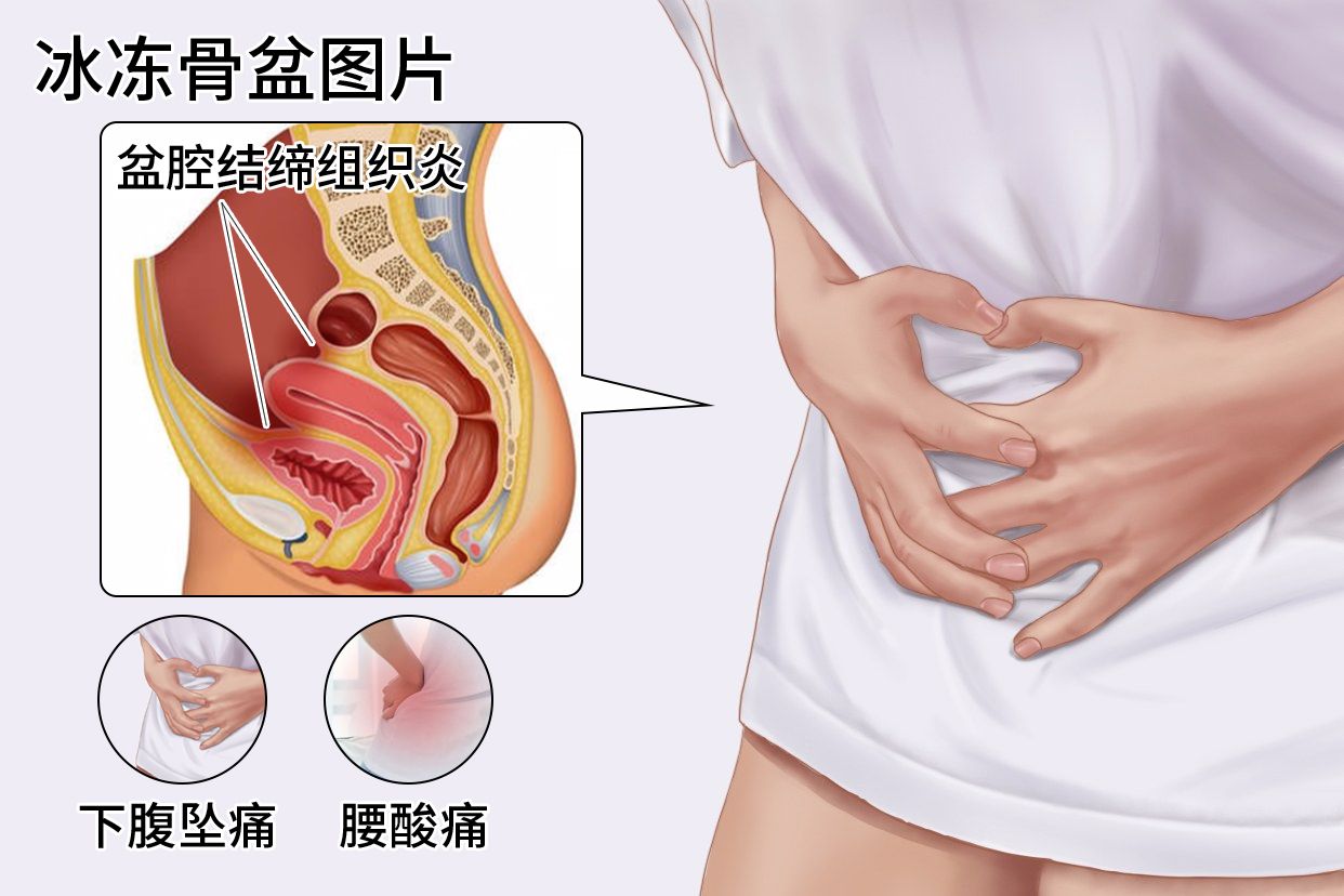 冰冻骨盆能活几年