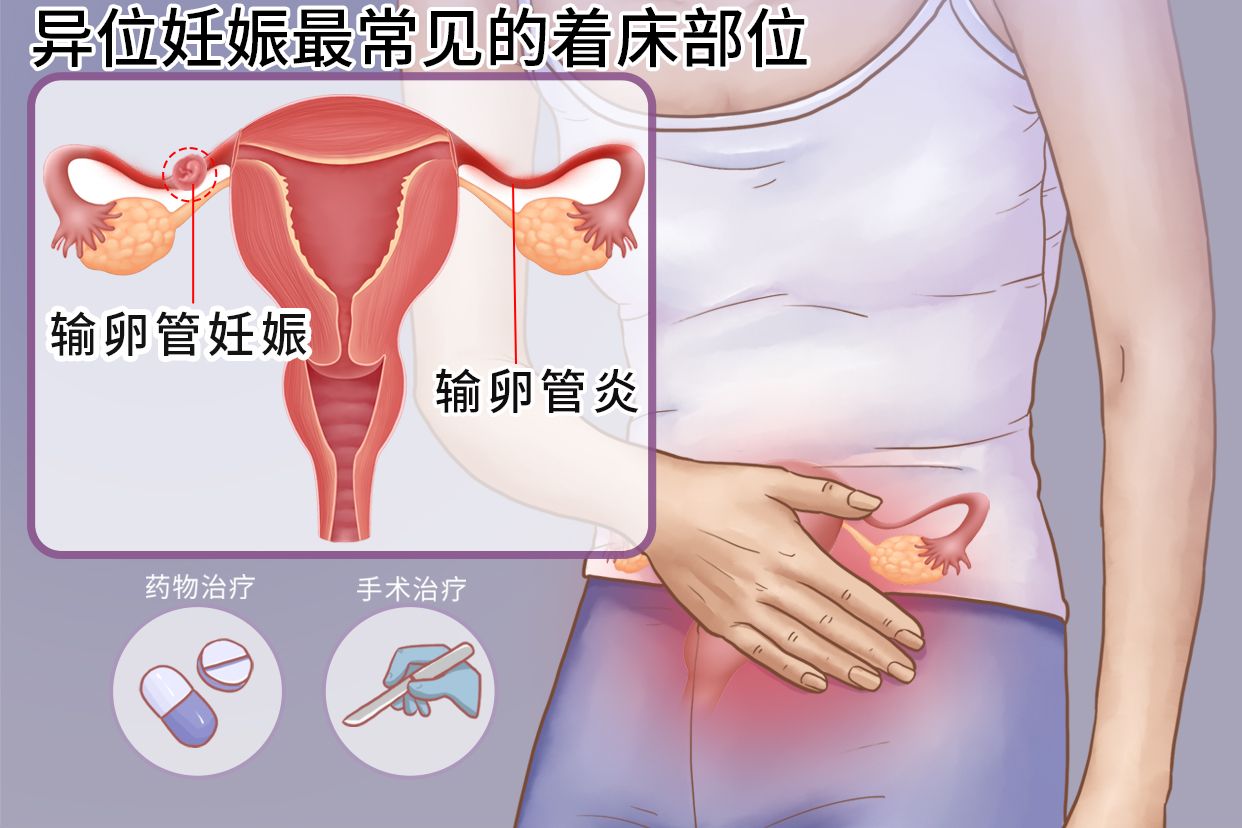 记录异位妊娠,右侧输卵管间质部妊娠