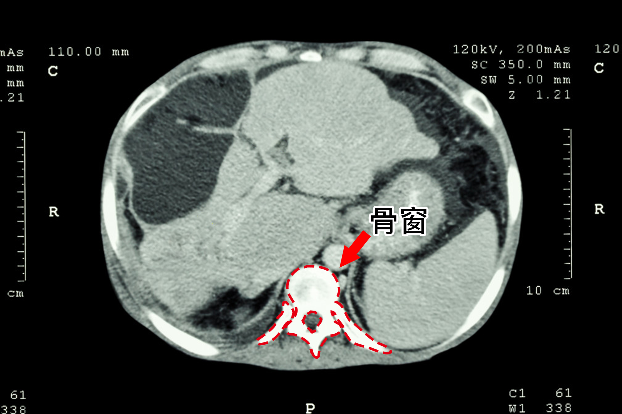 胸部CT纵隔窗可以看到胸骨肿瘤吗