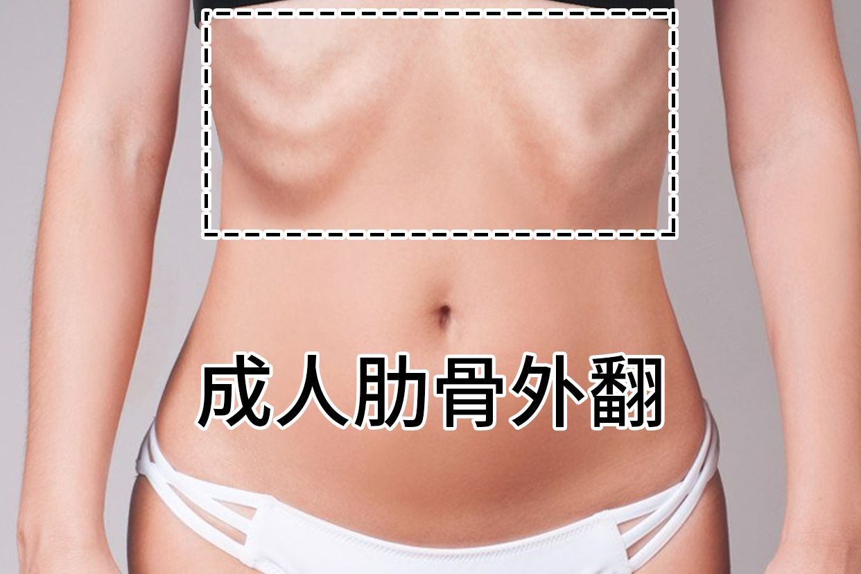 成人肋骨外翻手术多少钱
