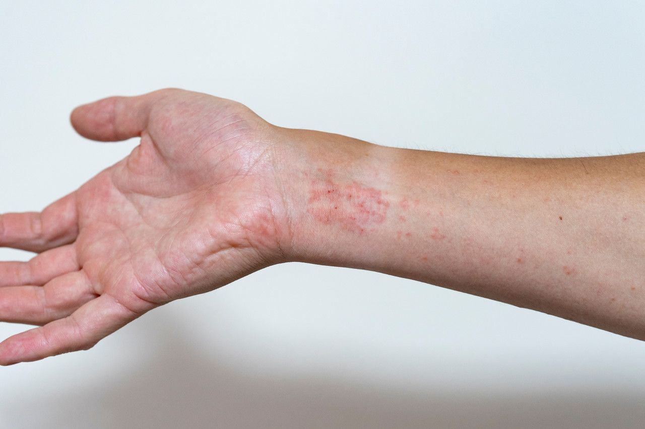 湿疹是什么原因造成的,手上湿疹怎么才能根除?