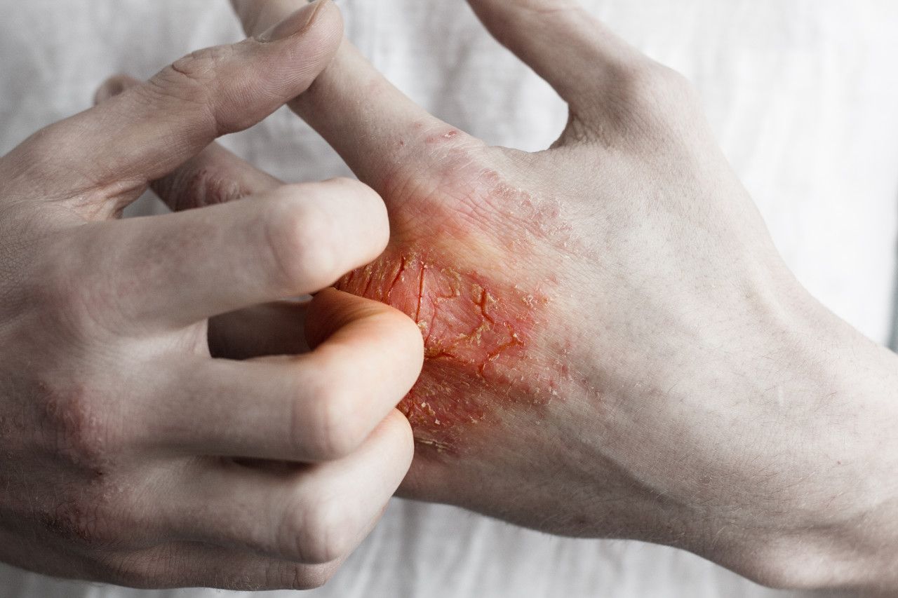 湿疹反复发作怎么办？6个预防方法帮您摆脱它！