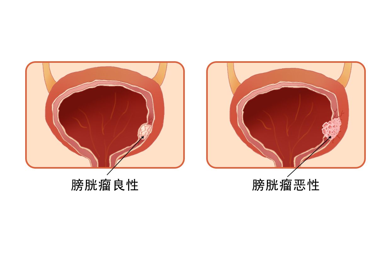 膀胱肿瘤的症状图片