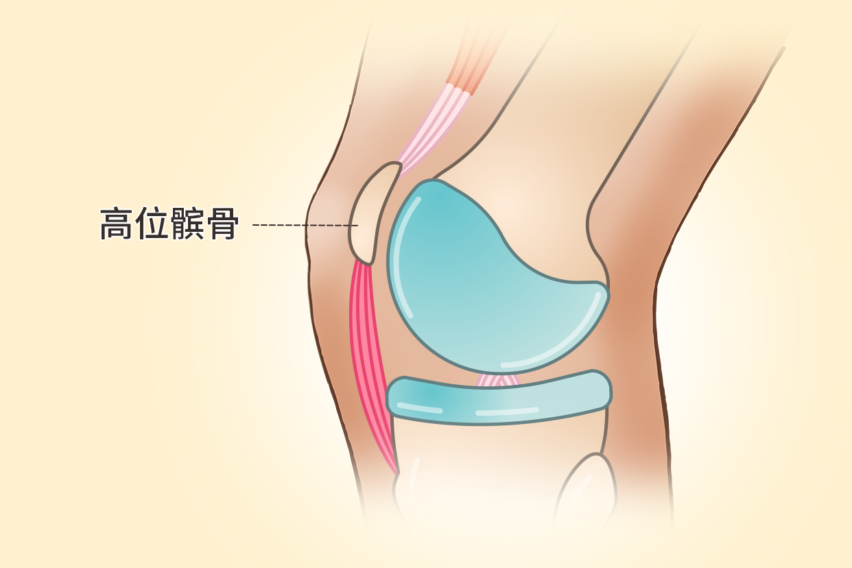 高位髌骨图片