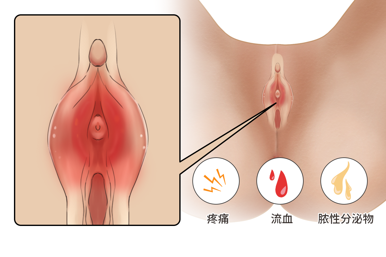 女の子 尿道口画像 尿道口发炎图片_39健康网