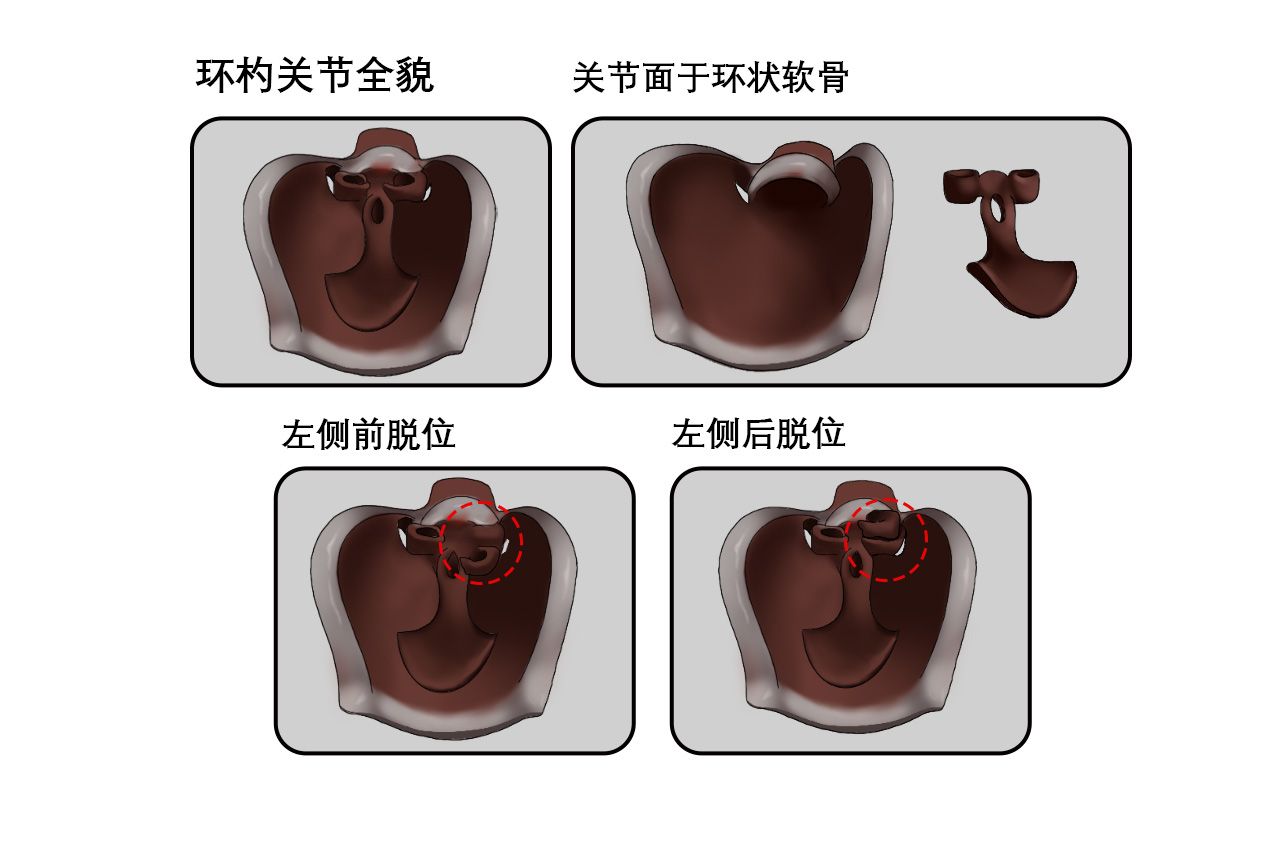 环杓关节脱位图片