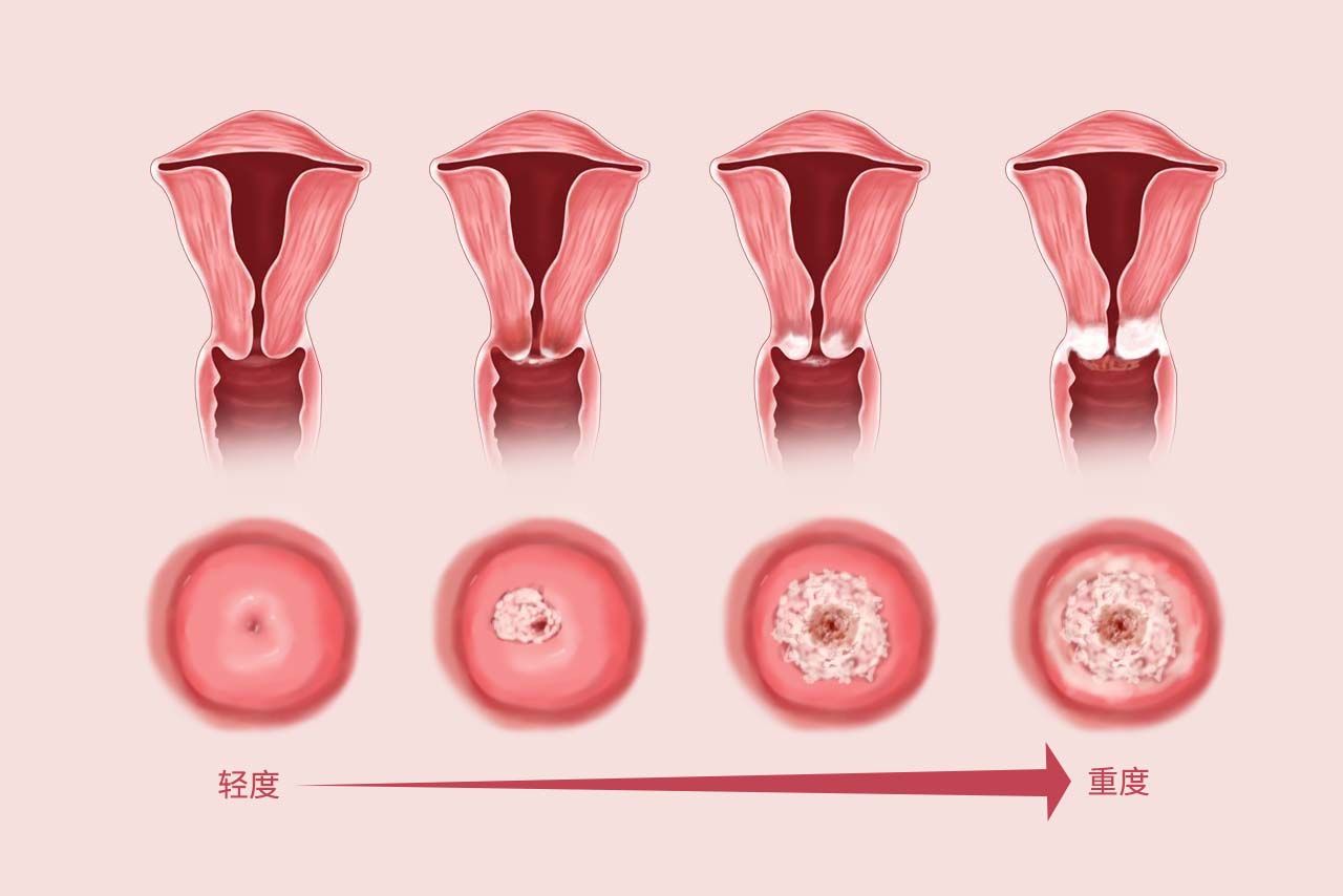 女性霉菌感染对比