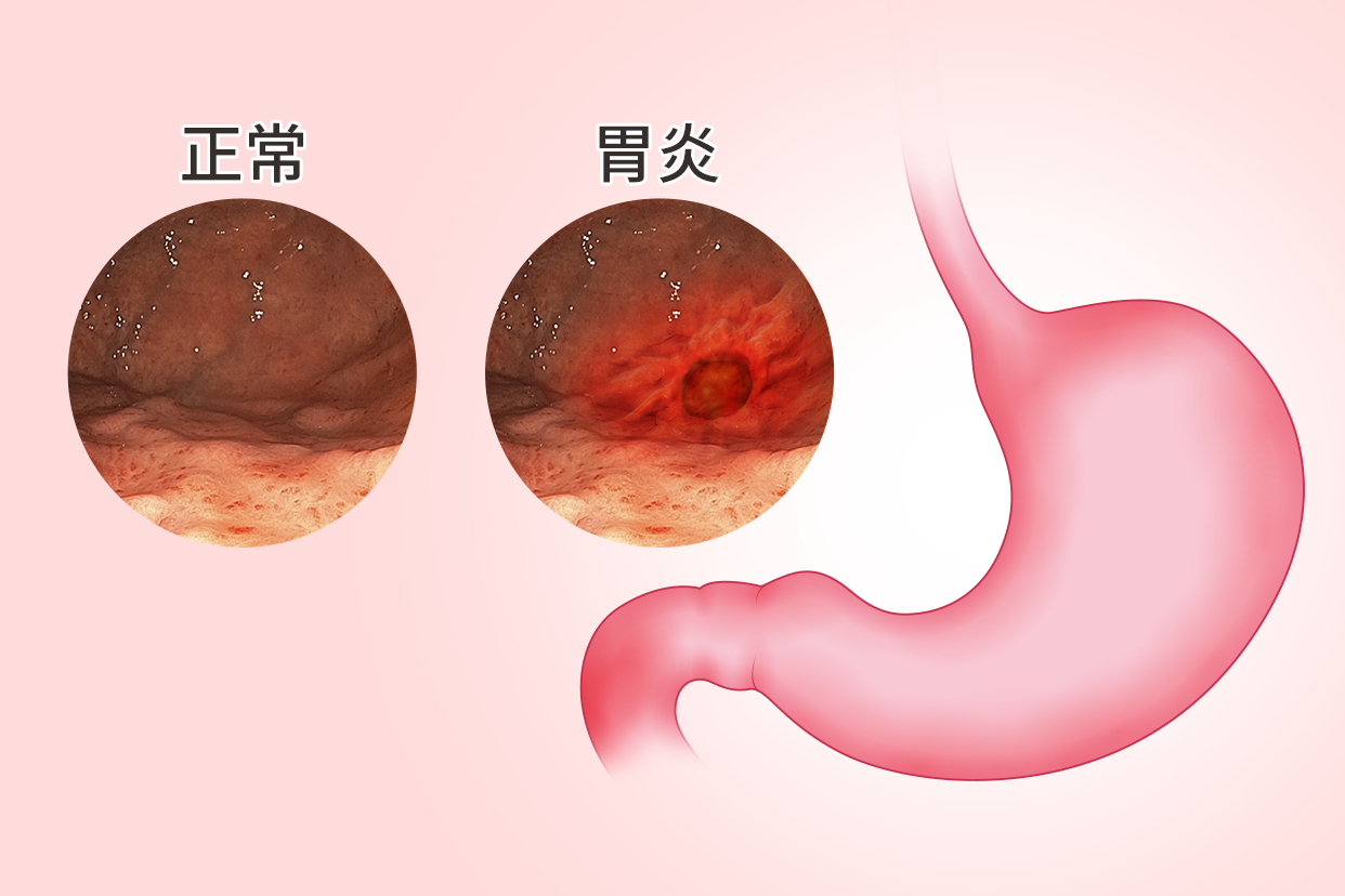 正常胃部与胃炎胃部图