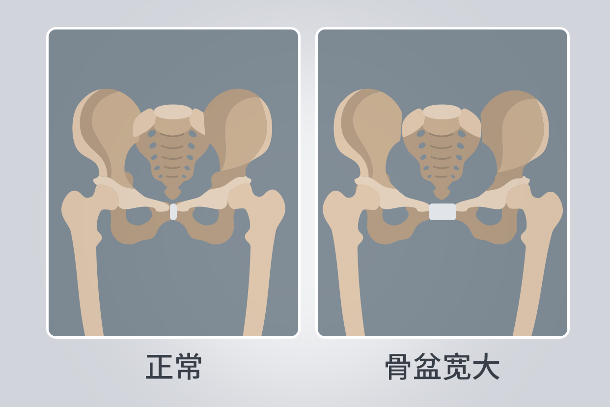先天性髋关节发育不良加骨盆前倾脊椎侧弯