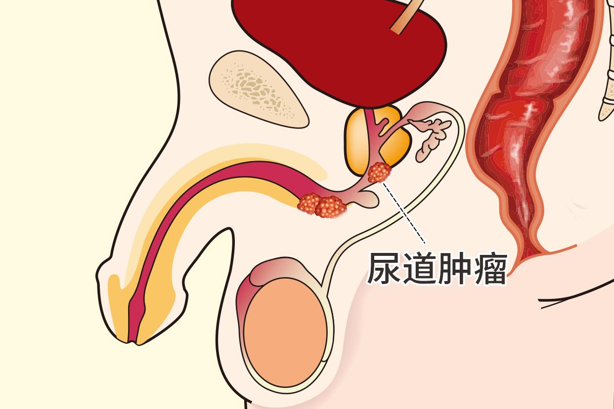 尿道肿瘤图片