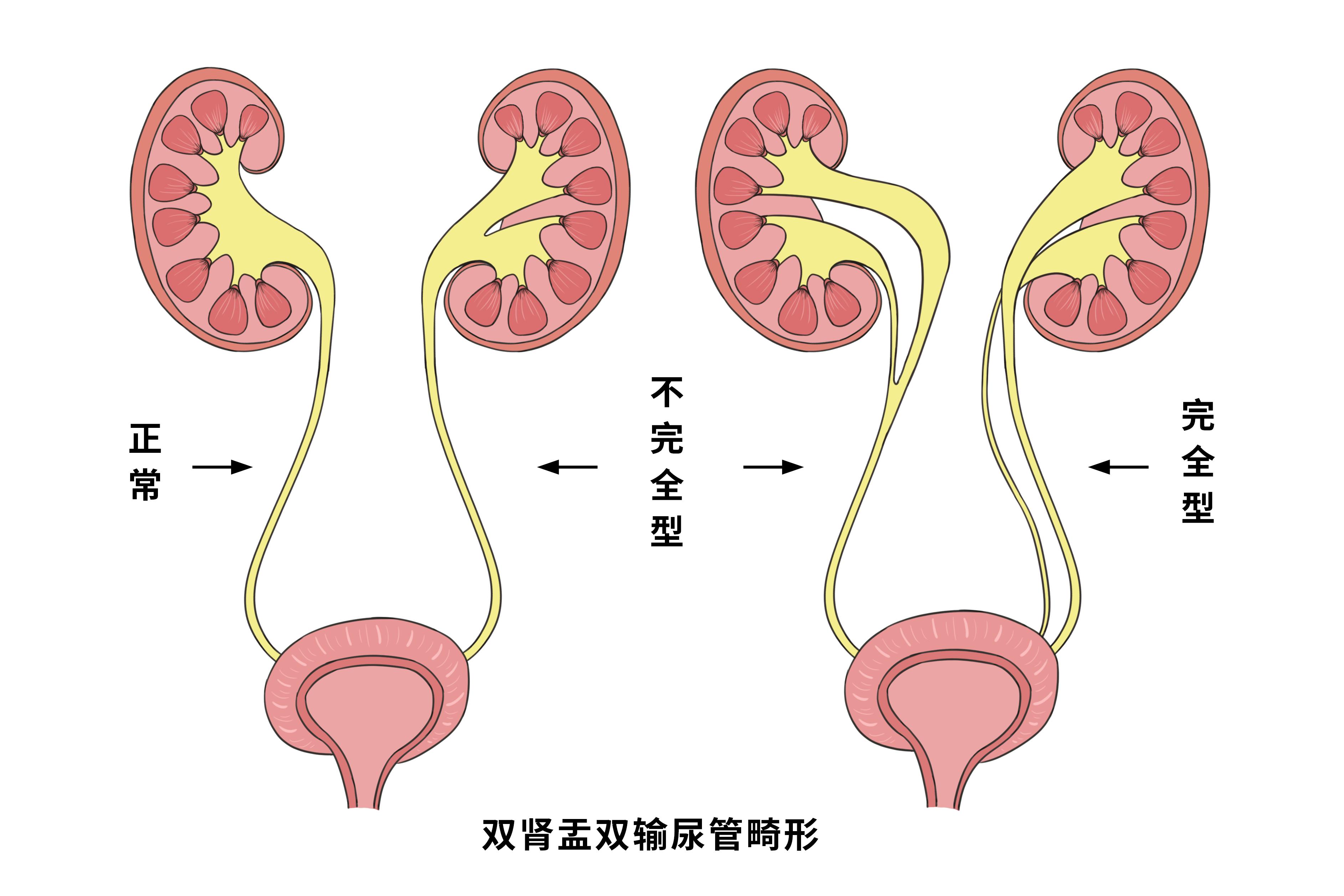 输尿管走形图片图片