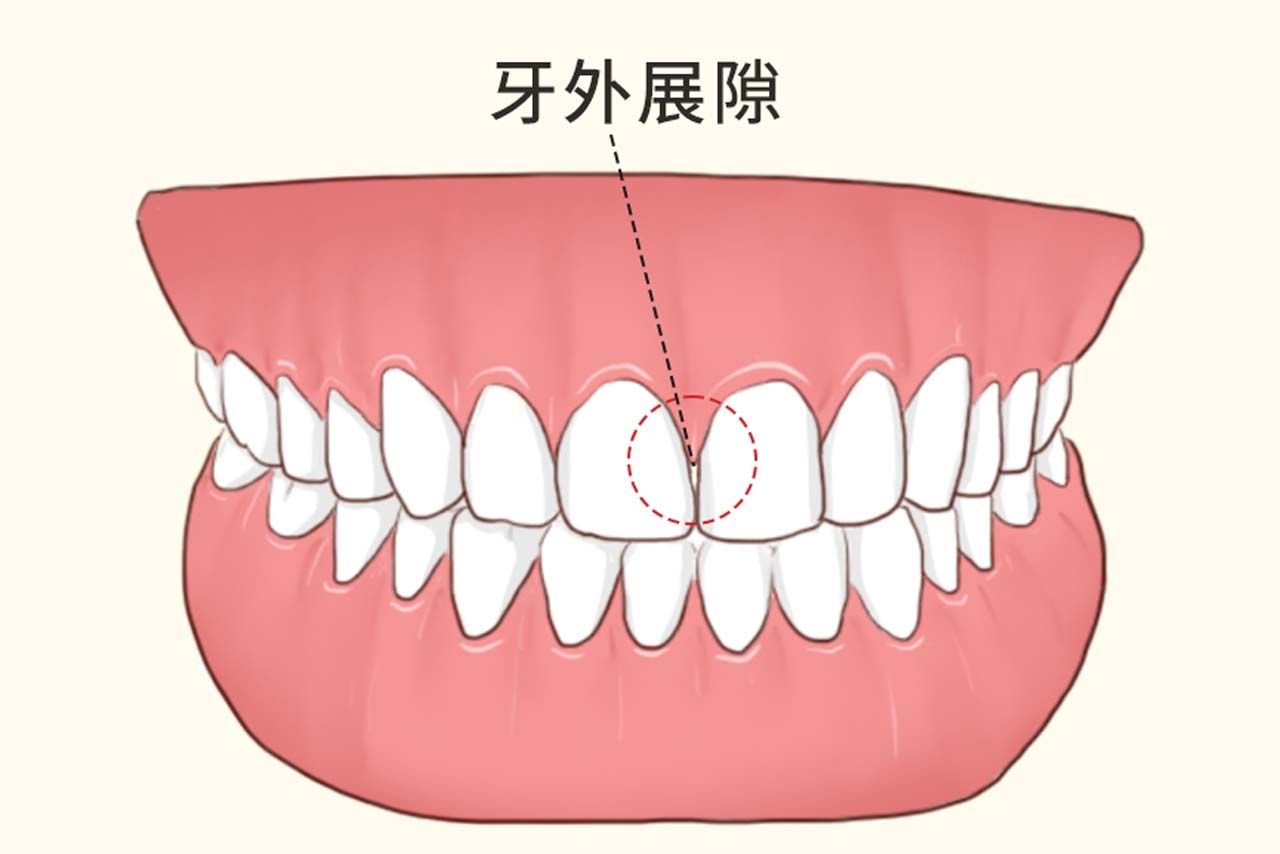 牙外展隙图