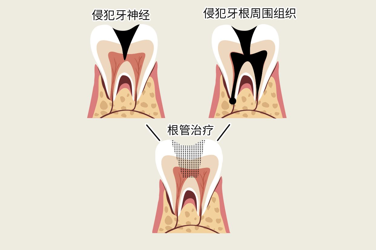 牙烂图片