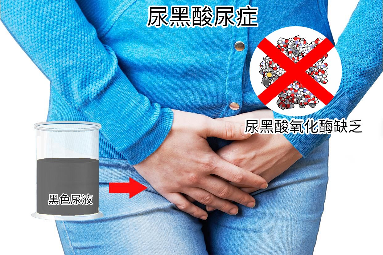 黑尿症是什么遗传病