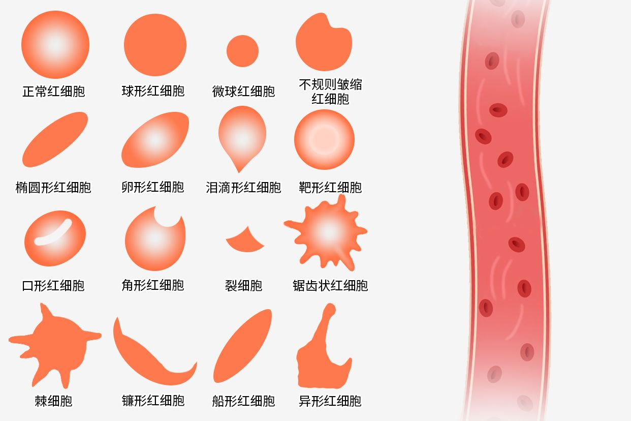 异常红细胞形态图