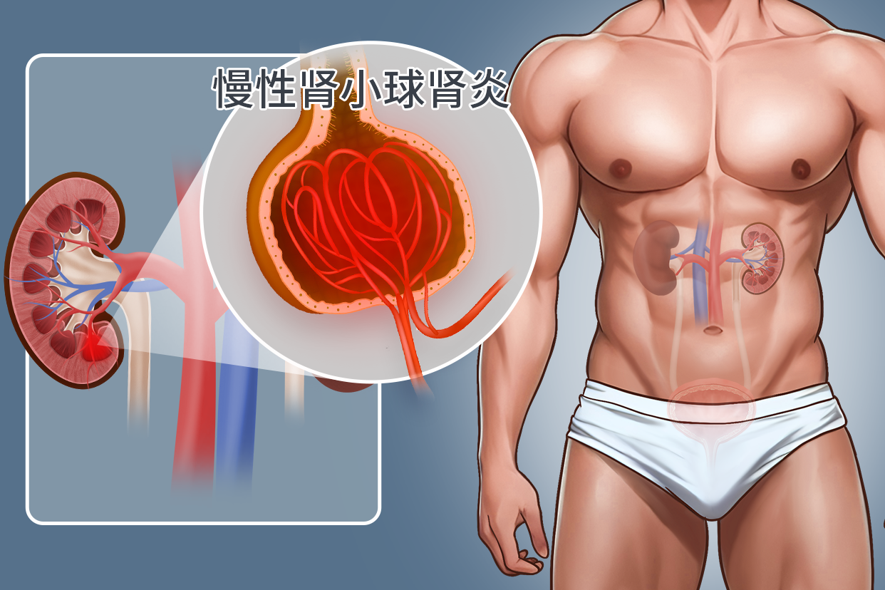 慢性肾小球肾炎图片