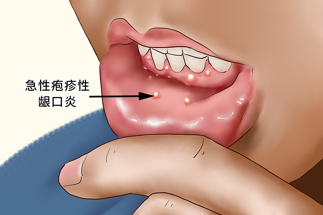 急性疱疹性龈口炎的临床特征为