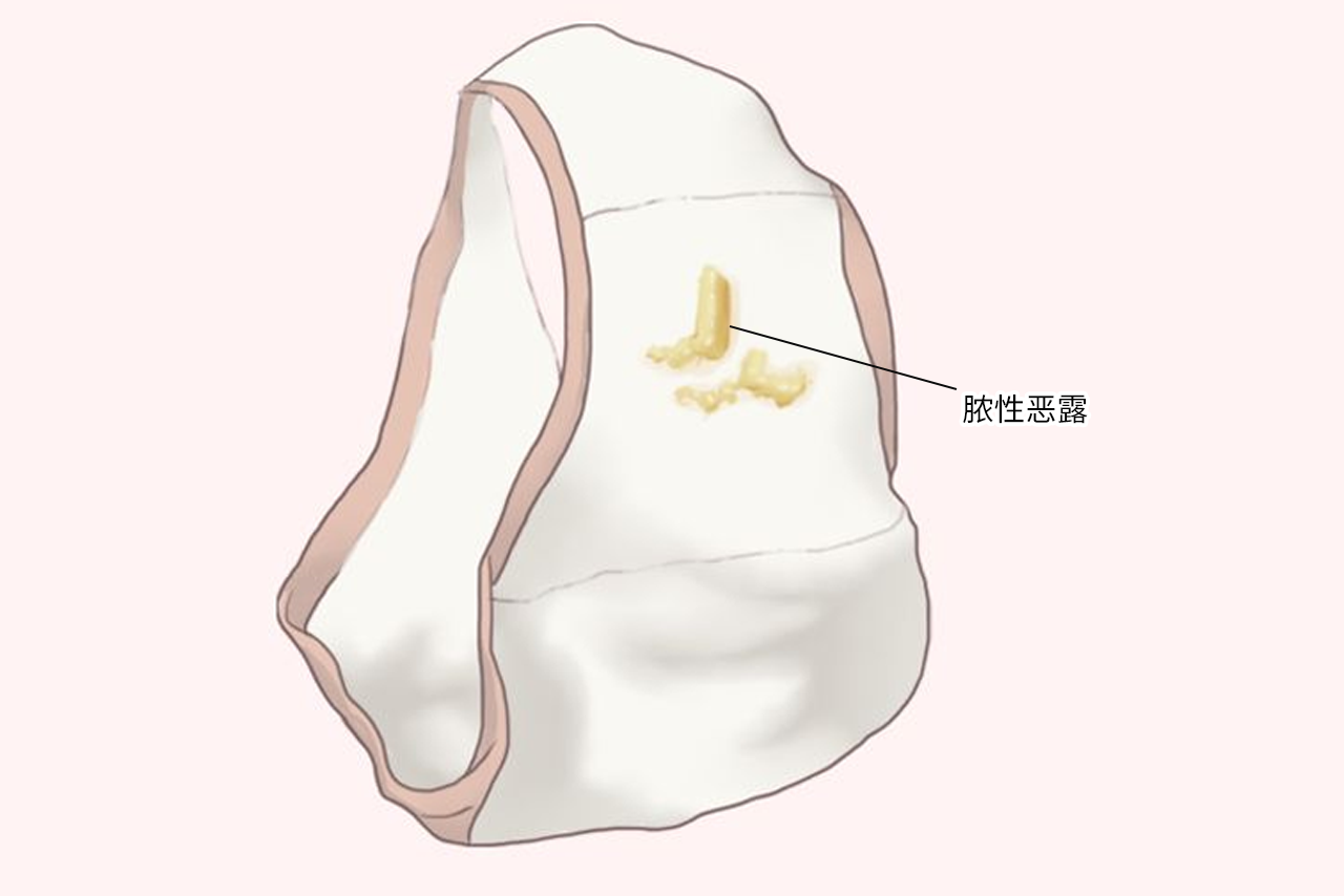 脓性恶露是快干净了吗