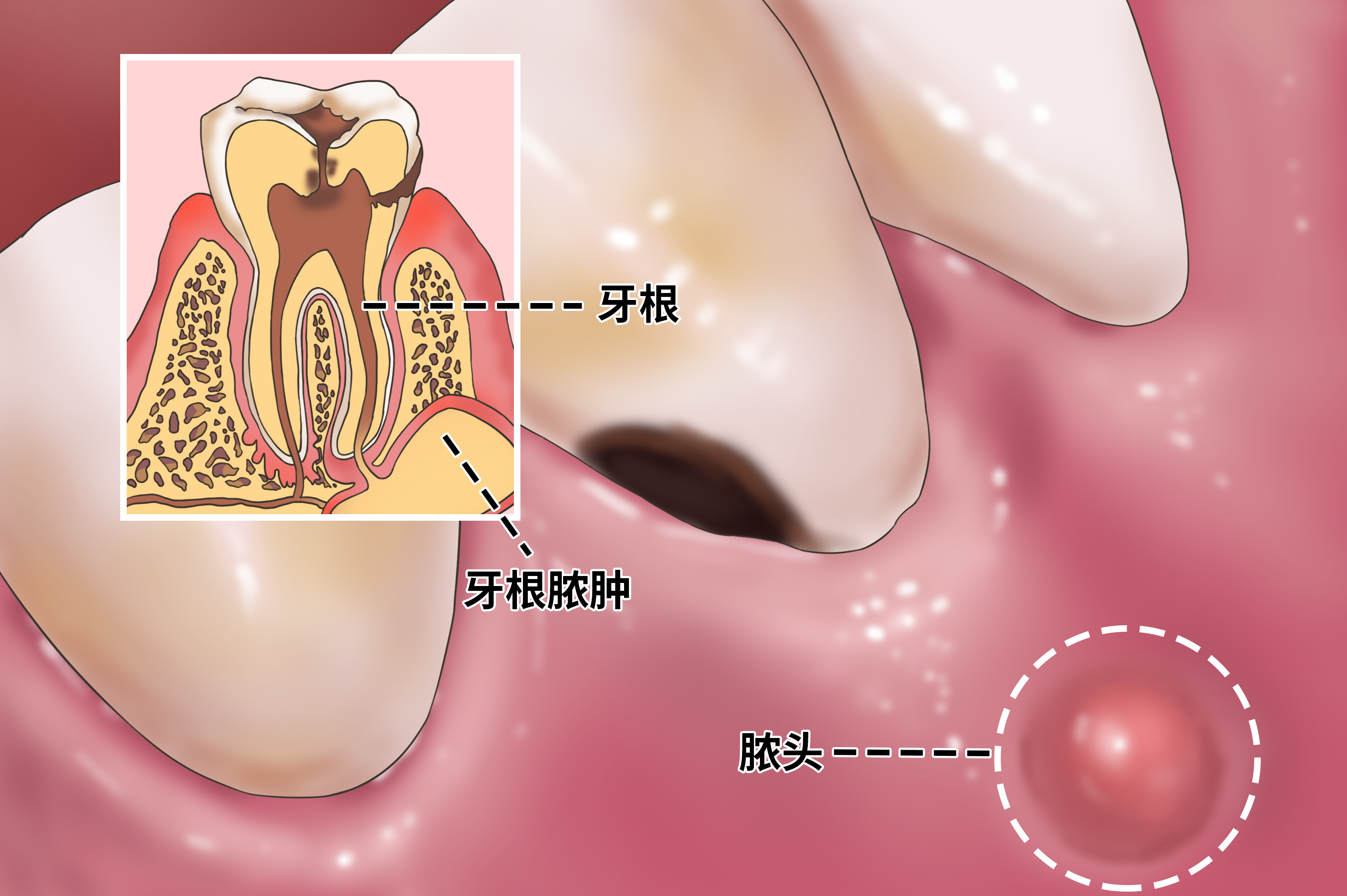 牙根脓肿为什么要通过根管治疗才行看完你知道原因了吗
