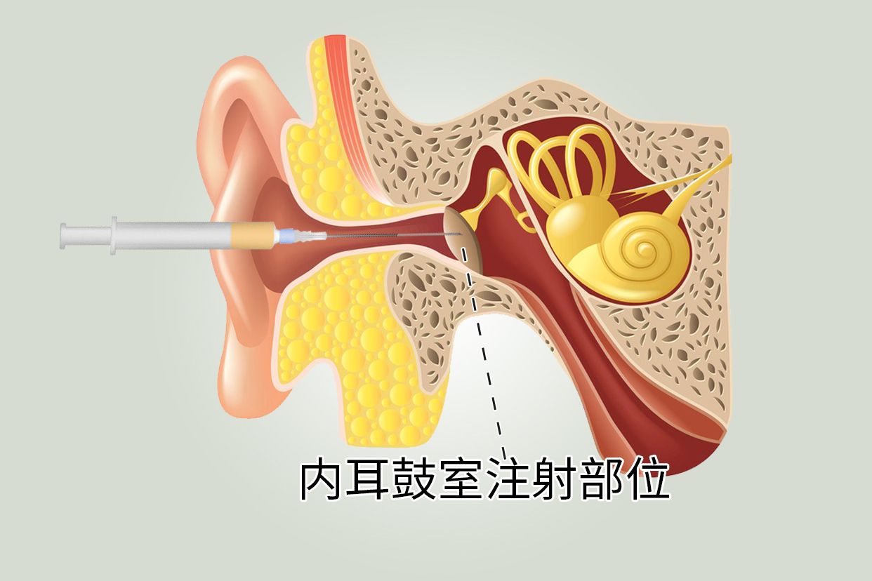 内耳鼓室注射多久可以做高压氧