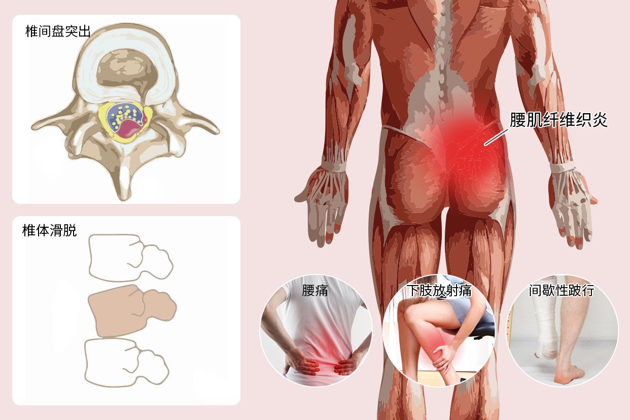 腰椎病的分类和临床表现图片