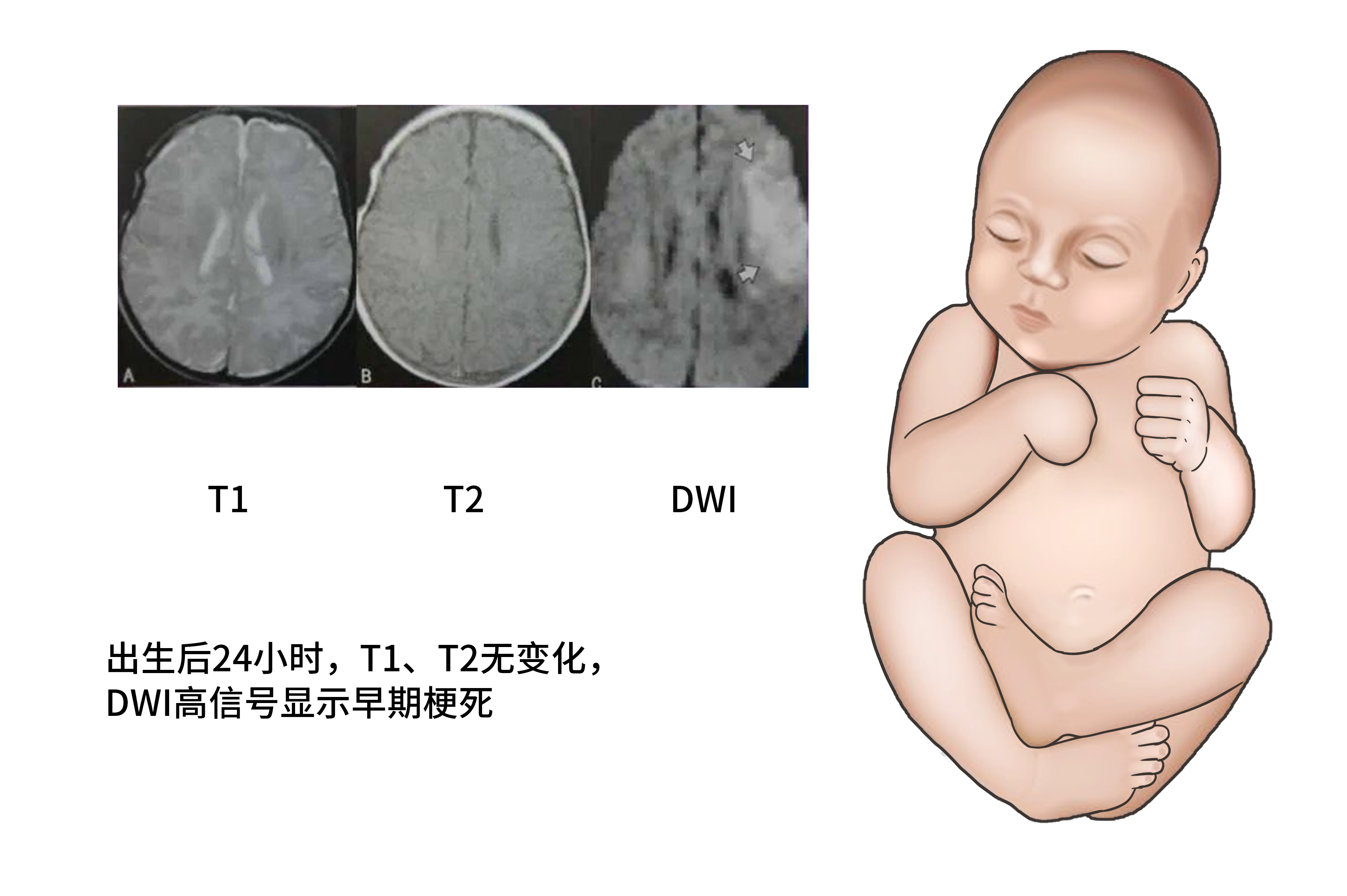 儿童脑缺氧受损磁共振检查图片