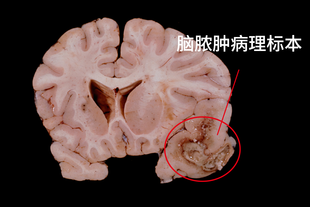 脑脓肿病理标本绘图