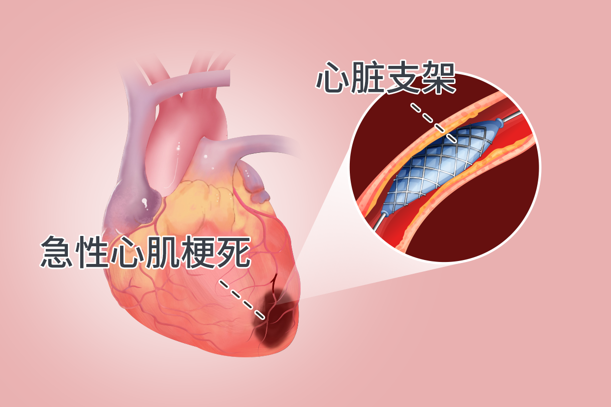 急性心肌梗死支架图片