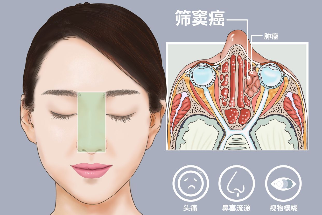 筛窦癌的症状图片