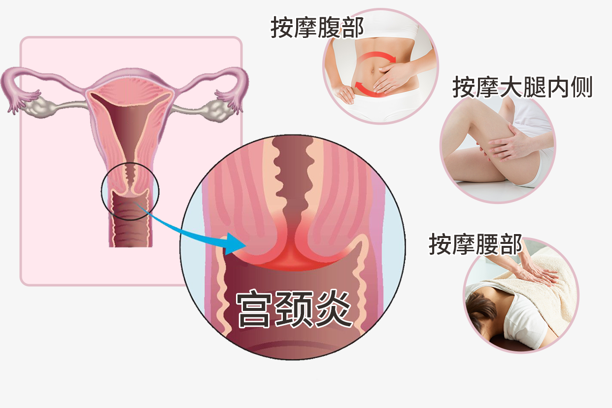 宫颈炎按摩示意图