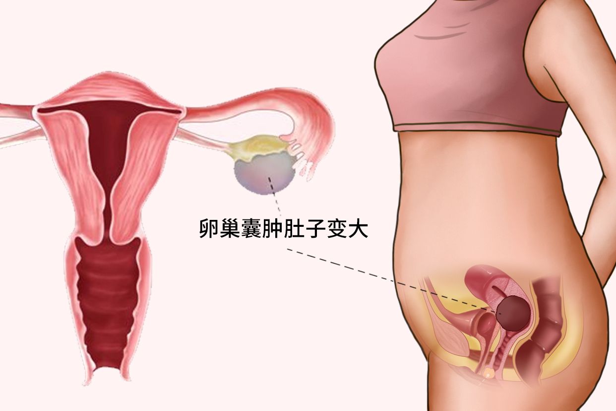 卵巢囊肿肚子变大图