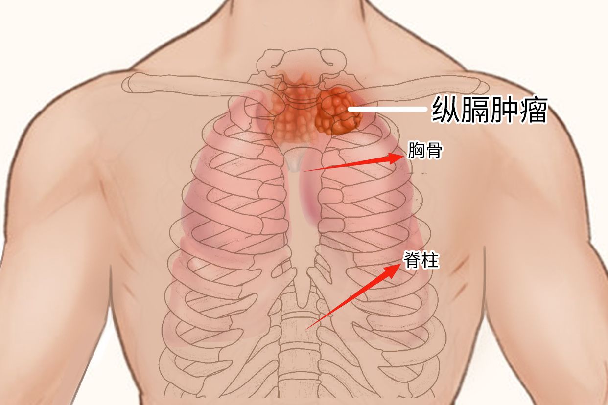 呼吸系统|胸部外伤,纵隔肿瘤