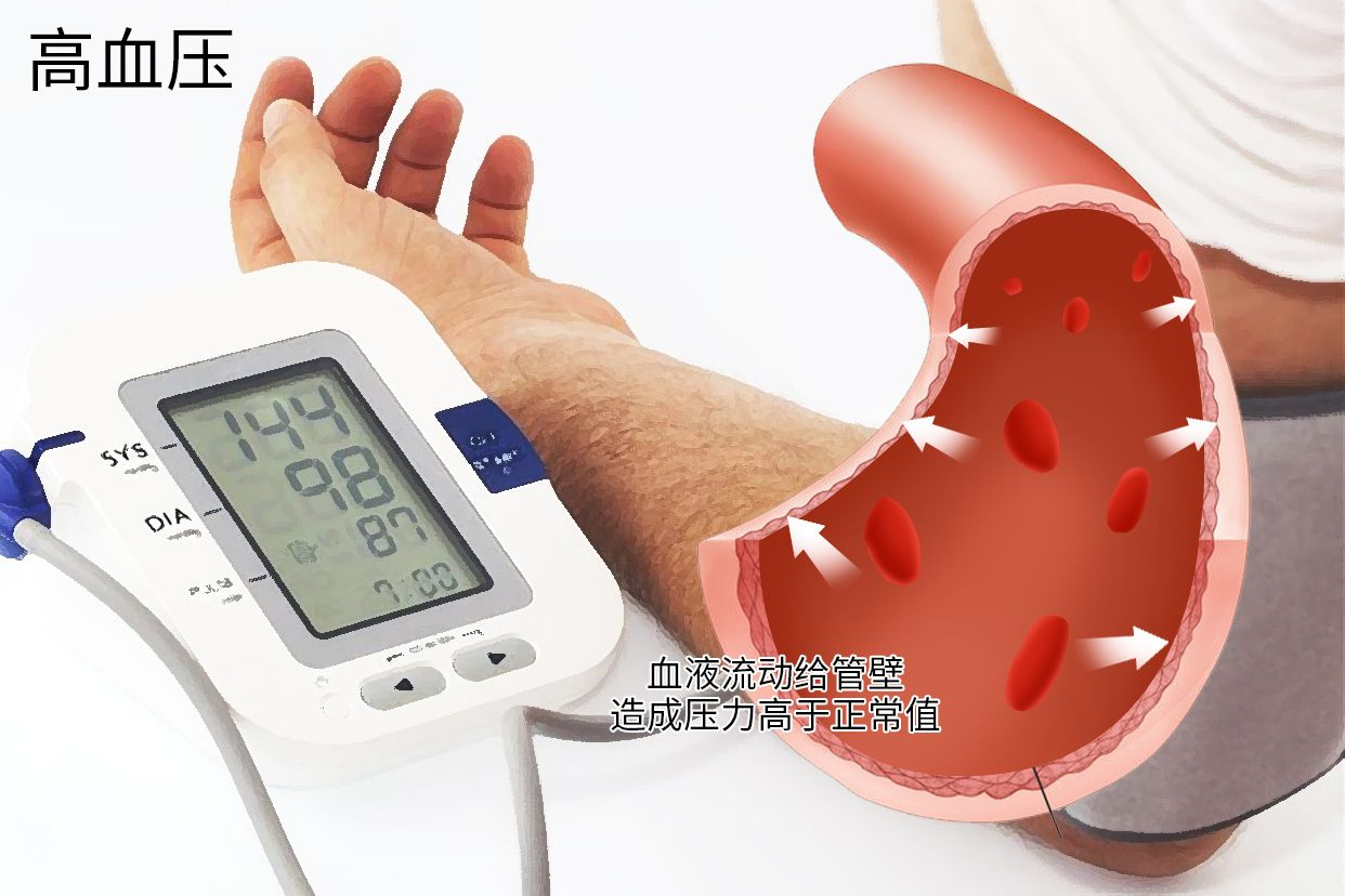 高血压怎么办?如何治理?