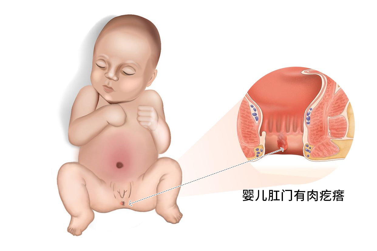 三个月婴儿肛门有肉疙瘩图片