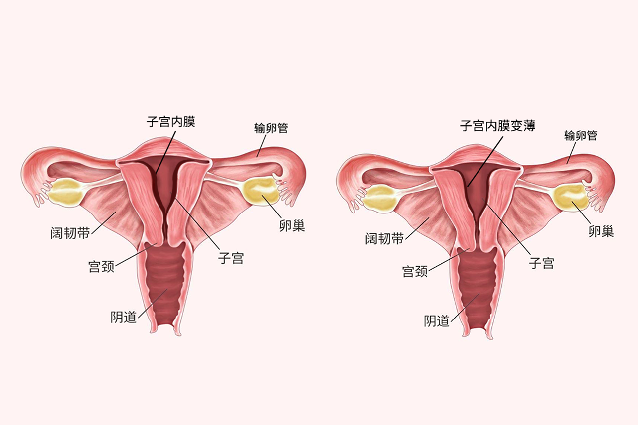 子宫内膜薄图片