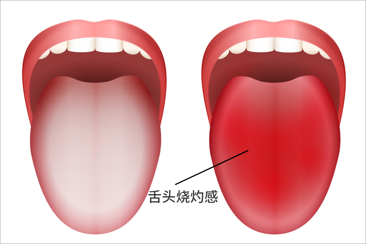 舌头总是有烧灼感疼怎么回事
