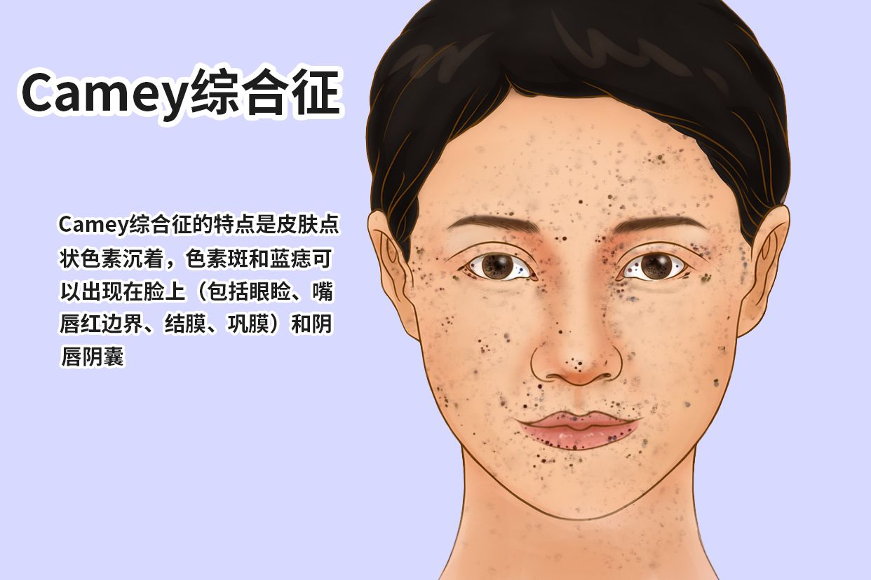 carney综合征遗传下一代吗