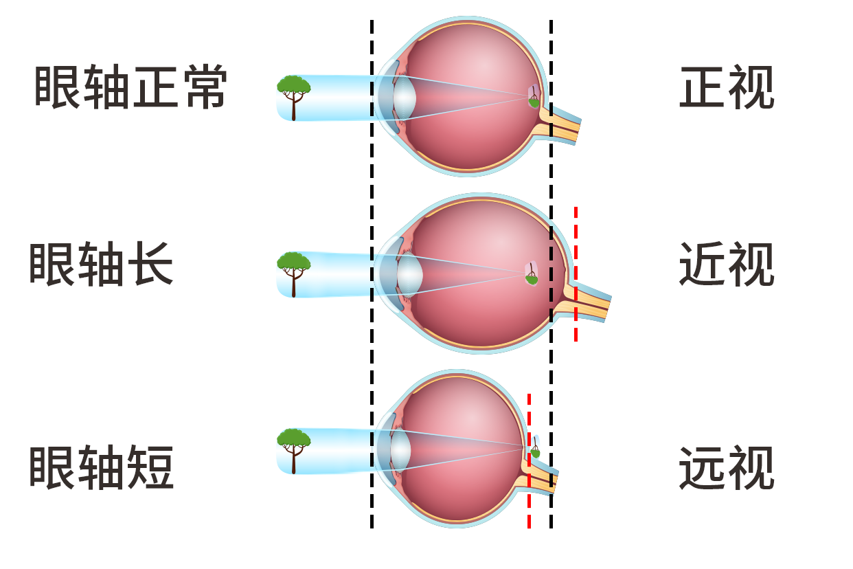 眼轴变化图