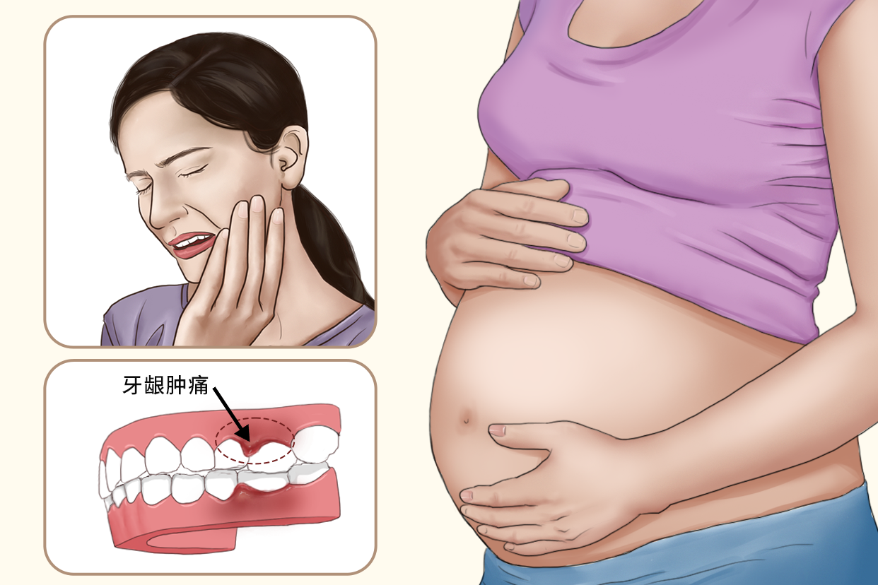 有被牙龈肿痛折磨的孕妇吗???