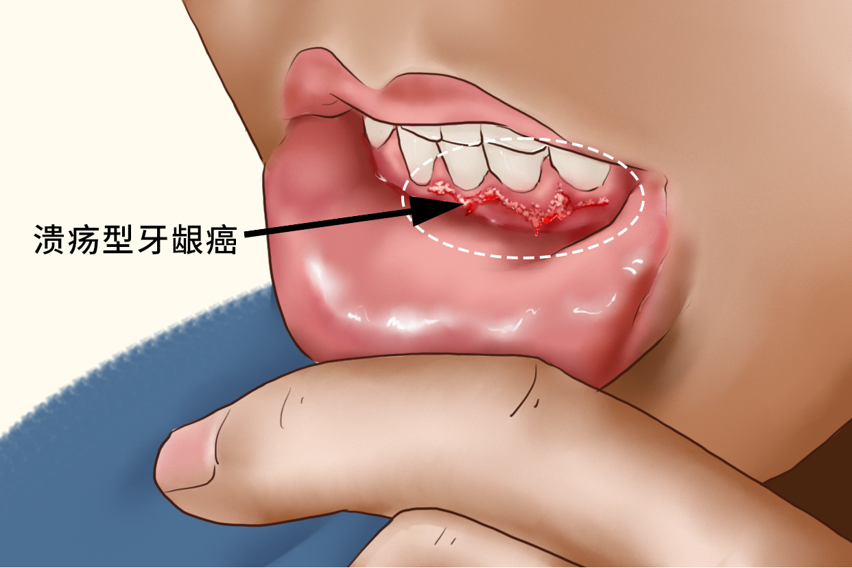 牙龈肿瘤症状图片