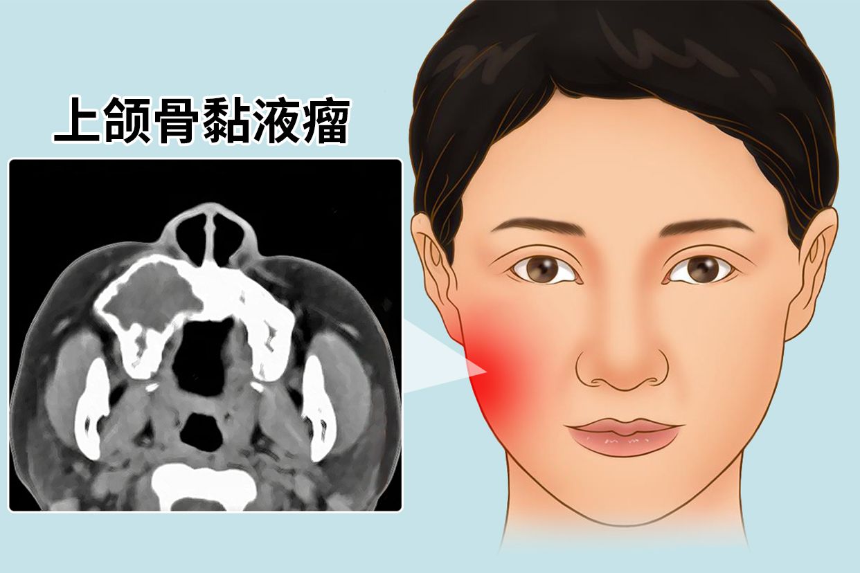 上颌骨粘液瘤会长几十年吗